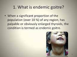 The prevalence of endemic goiter varies with the severity of iodine deficiency (3;21). Ppt Endemic Goiter In S Ri L Anka Powerpoint Presentation Free Download Id 2207796