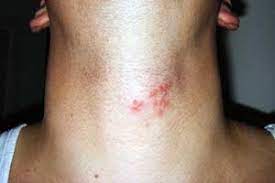 Was Ist Gurtelrose Ursachen Symptome Behandlung Krank De