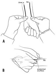 Image result for Allen Test