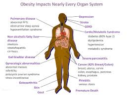 Image result for Obesity