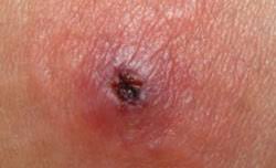 What are the long term effects of mrsa? Ca Mrsa Lesions What Works What Doesn T Mdedge Family Medicine