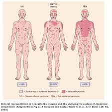 2015 Answers To April S Clinical Image Steven Johnson Syndrome Steven Johnson Medical School Stuff