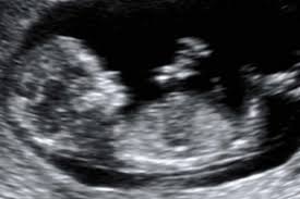 Raising your body temperature above 102°f (38.9°c) increases the risk for birth defects (such as neural tube defects) in the first trimester and dehydration later in the pregnancy. Is It Ok To Use A Hot Tub During Early Pregnancy Your Pregnancy Matters Ut Southwestern Medical Center