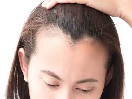 علاج ثعلبة الحواجب بالثوم