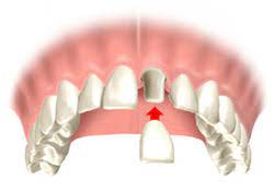 Wann ist eine krone notwendig? Kronen