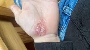 Image result for dyshidrosis