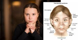 Also called epicanthal fold, epicanthic fold. Does Greta Thunberg Have Fetal Alcohol Syndrome