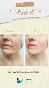 Dr Malcolm Lesavoy. Showing you how beautiful eyes, lips, noses and skin  can look... come and see Dr Lesavoy for a free consultation. In Beverly  Hills, 📪 421 Rodeo Drive !!! Www.lesavoyplasticsurgery.com