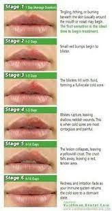 When is a cold sore no longer contagious. Cold Sores Cold Sore Stages Cold Sore Prevention Cold Sore Treatment