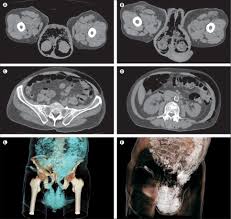 Check spelling or type a new query. Fournier S Gangrene Complicating Thrombocytopenia Treated With Steroids The Lancet