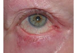 The eyelid skin is the thinnest in the body and lacks subcutaneous fat, but otherwise contains all other skin structures. Eyelid Skin Cancer Mivision