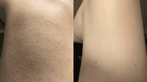 Image result for Keratosis pilaris