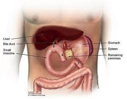 Whipple Procedure Pancreaticoduodenectomy With Images Whipple Procedure Surgery Pancreas Health