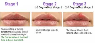 The first outbreak of herpes 1 is usually the worst. Herpes Cure Cancer Early Rpdh Kids Nv Ru