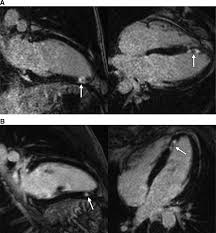 Image result for Cardiac Contusion