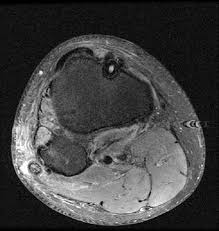 These muscles work in groups to flex, extend and stabilize the extending along the anterior surface of the thigh are the four muscles of the quadriceps femoris group (vastus lateralis, vastus medialis, vastus. Common Peroneal Nerve Abnormalities Radsource