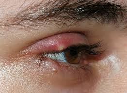 Florida eye care and contact lens center* lawrence sider, od 2200 glades road ste 105 boca cowling eye care daniel l. Stye Wikipedia