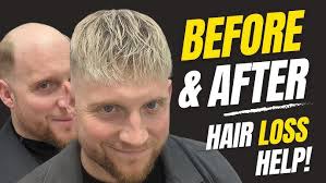 How Effective is a Hair Replacement System for Men in the Sea with Phil  Osmond