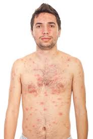 Homem Com Varicela Fotos Fotos De Stock Gratuitas E Fotos Royalty Free Dreamstime