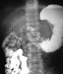 Image result for Intestinal Malrotation
