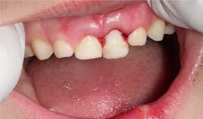 Urgencias Dentales En Getxo Clinica Dental Letamendia