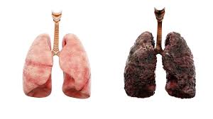 Image result for Lung Cancer