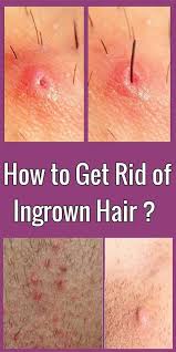 You need to leave the area alone so it doesn't get irritated or develop an infection. How To Get Rid Of Ingrown Hair With Baking Soda In 2021 Get Rid Of Ingrown Hairs Ingrown Hair Treat Ingrown Hair