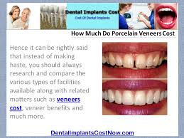 Maybe you would like to learn more about one of these? How Much Do Porcelain Veneers Cost Dentalimplantscostnow Com By Ppt Download