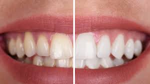 Image result for Tooth Discoloration