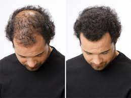 Male pattern hair loss is from genes. Toppik Review Updated 2021 Don T Buy Before You Read This
