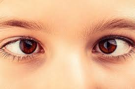 Image result for Strabismus