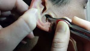 Le tout gonfle avec l'eau et peut avoir des répercussions. Ce Type Se Fait Enlever Le Plus Gros Bouchon D Oreille Que J Ai Jamais Vu Immonde Video Dailymotion