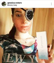 Gessica notaro, 27, was badly scarred and is in danger of losing the sight of an eye. Prodotti A Base Di Cellule Staminali Y E S Posts Facebook