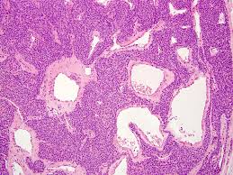 Image result for Glomus tumor