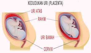 Dr mohd ramzdhan bin mohd masdar. Uri Rendah Ibu Hamil Patut Ambil Tahu Kesan Cara Jaga Untuk Elak Pendarahan Teruk Mingguan Wanita