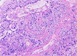 Glioblastoma is the most common type of malignant brain tumor in adults. Long Term Survival In An Esophageal Cancer Patient With Multiple Recurrences Springerlink