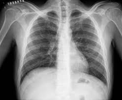 Fibroza pulmonară este o afecțiune cunoscută și sub denumirea de pneumopatie interstițială difuză fibrozantă, caracterizată prin înlocuirea patologică a interstițiului pulmonar cu un țesut conjunctiv, sclerozant, secundar depunerii la nivel interstițial și alveolar a unor componente celulare inflamatorii. Campanie De Informare La Cluj Fibroza PulmonarÄ IdiopaticÄ La Fel De AgresivÄ Precum Tumorile Canceroase Dej24 Ro