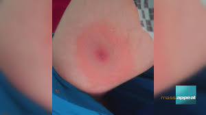 Image result for infected tick bite