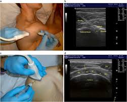 Image result for Subacromial Space Injection
