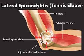Image result for Epicondyle Injection