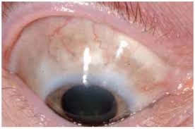 Image result for melanosis sclera