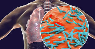 Image result for Tuberculosis