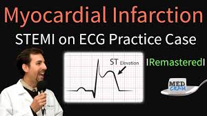 Myocardial Infarction Stemi On Ecg Practice Ekg Youtube