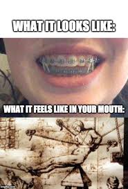 This Is What Happens When You Get Your Braces Tightened Imgflip