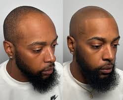 Beautifully done 2nd session for this client! Featuring a sharp,  natural-looking barber edge hairline. We can create any style of hairline  you desire, customized to fit your unique look. Achieve the hairline