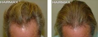 Before and After Plus Clinical Results Photos of Hair Growth – Hairmax