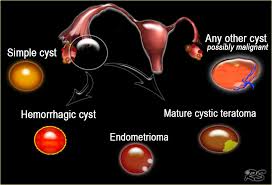 The Radiology Assistant Ovarian Cysts Diagnostic Work