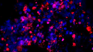 By combining the current prostate specific antigen (psa) test with the new test (the circulating tumour cell (ctc) test, this could help. Research Finds Achilles Heel For Aggressive Prostate Cancer Uc San Francisco