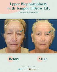 Before & After Upper Blepharoplasty with Temporal Brow Lift After this  combo surgery, the patient is looking bright-eyed and years younger! Dr.  Waters masterfully created a natural look with drastic improvement to