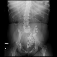 This Girl Born With A Meningomyelocele Has Had Bladder Augmentation Within Which Extensive Laminated Bladder Stones Have Fo Radiology Radiology Humor Bladder